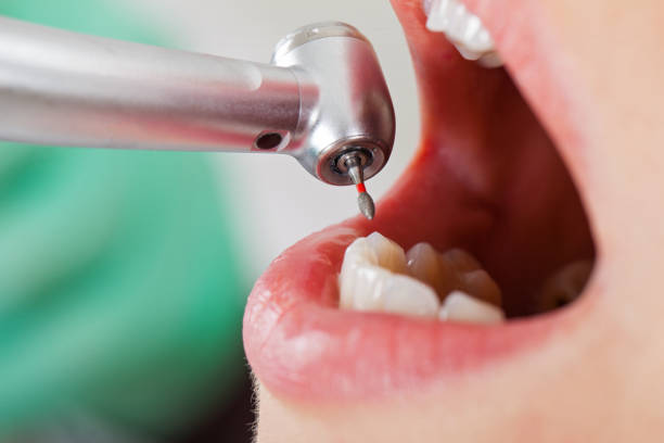 Best Urgent Tooth Repair  in Watsonville, CA